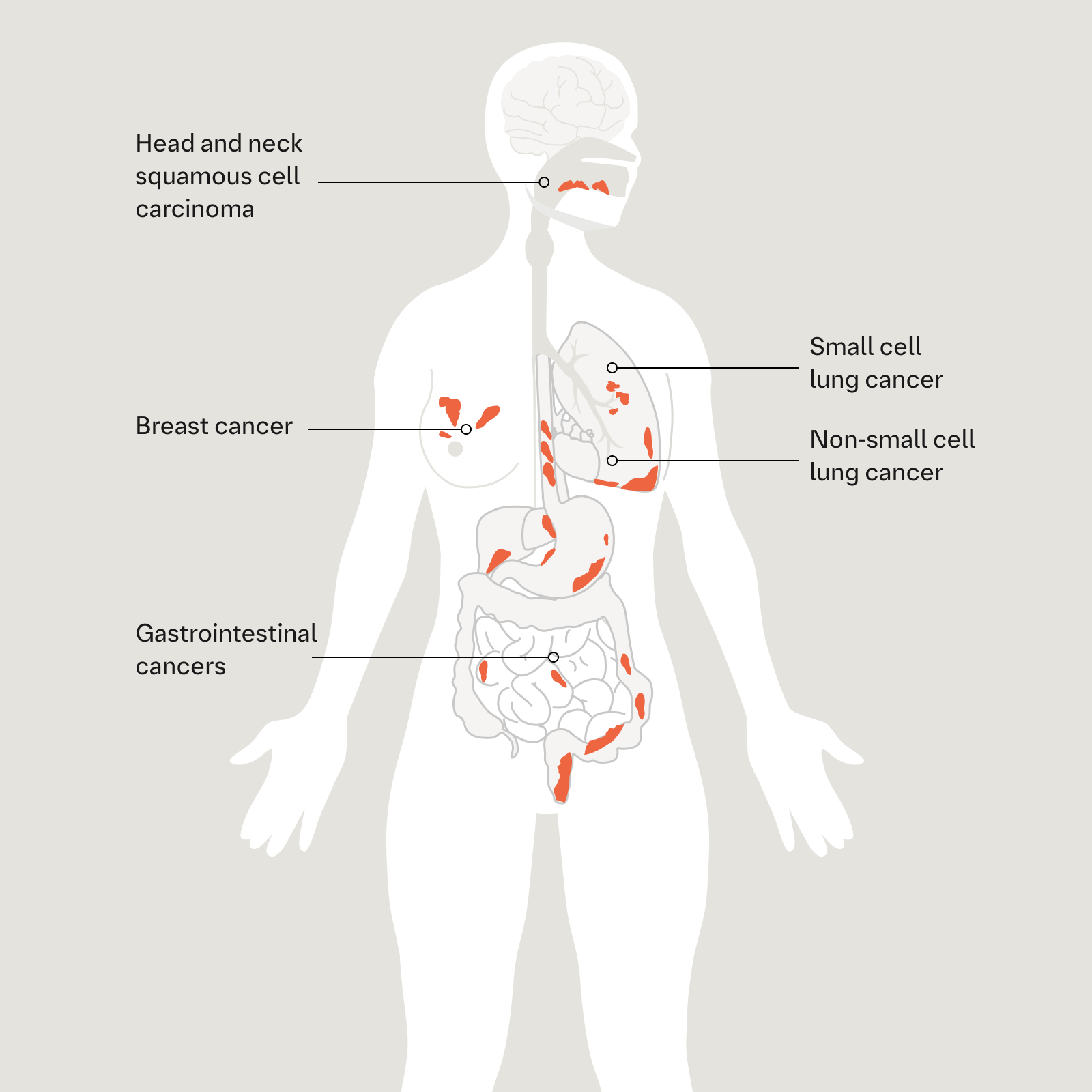 Tumor Types in Focus